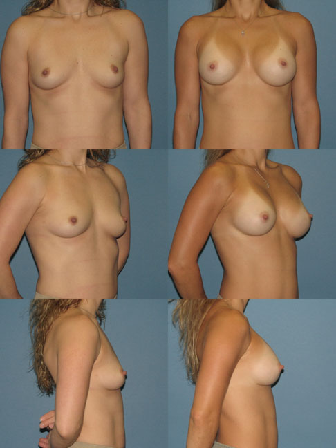 In the case of breast surgery, breast augmentation before and after pics 