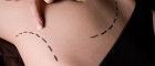 Liposuction