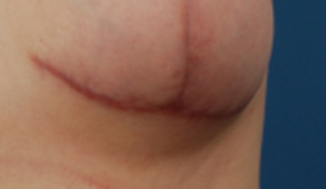 keloid scar pictures #11