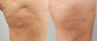 Cellulaze Before and After