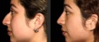 Rhinoplasty Before and After