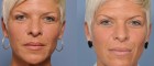 Facial Fat Grafting