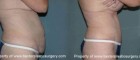 BaxterTummyTuck02