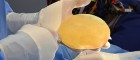Form stable breast implant