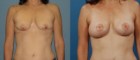 Capsular Contracture Capsular Contracture