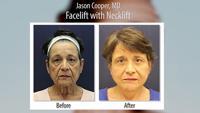 Face lift patient - Dr. Cooper.