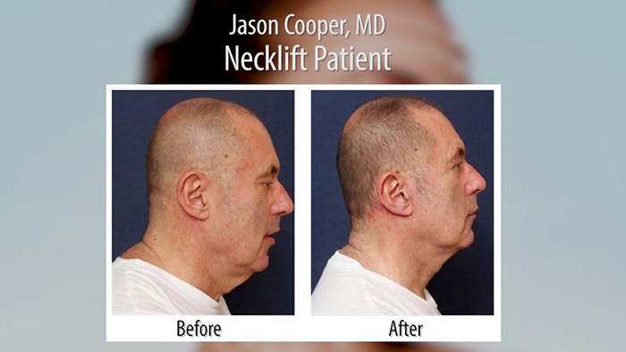 Neck Lift Patient - Dr. Cooper.