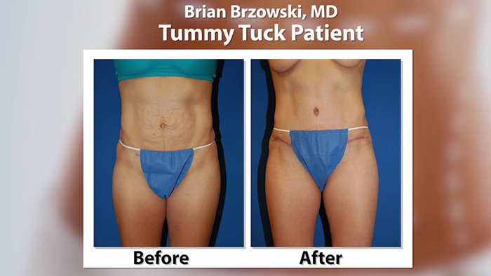 Mommy makeover - Dr. Brzowski before and after.