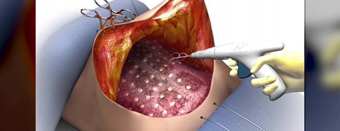 drainless tummy tuck recovery timeline drainless tummy tuck recovery timeline