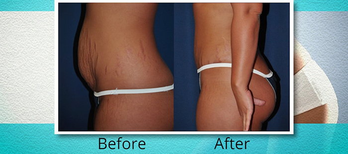 Lipoabdominoplasty - Dr. Paul Watterson.