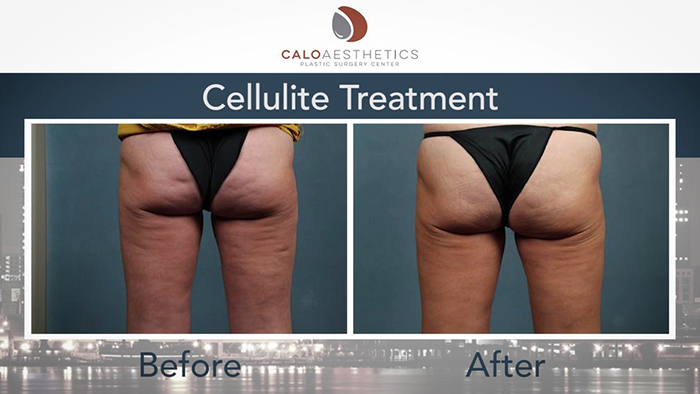 Cellulite treatments - before and after 2.