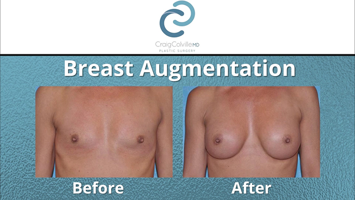 A harmonious breast augmentation.