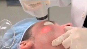 laser cosmetic surgery technology