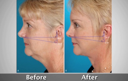 Facelift-before-and-after