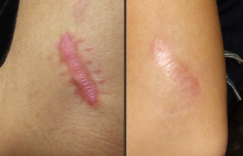 Treating Scars with Lasers