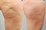 Cellulaze Before and After