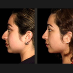 Rhinoplasty Before and After