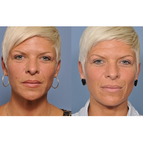 Facial Fat Grafting