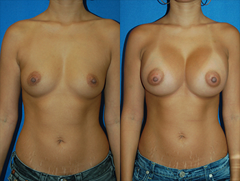 Transaxillary Breast Augmentation