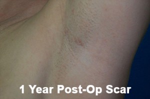 Scar from transaxillary breast augmentation