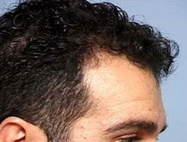 NeoGraft Hair Transplant After