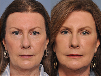 facial fat grafting