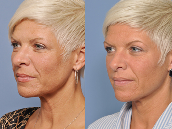 Facial Rejuvenation