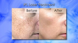 IPL laser