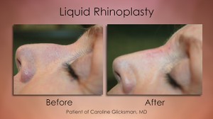 "Before and After Rhinoplasty"