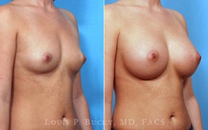 breast-augmentation