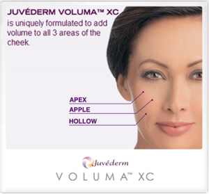 juvederm xc