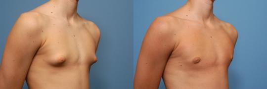 Male-Breast-Reduction--Gynecomastia-Dr.-Bruce-W.-Van-Natta-528