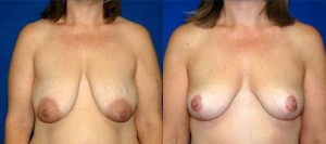 breastlift1