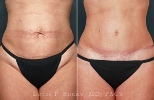 abdominoplasty-06a-wm