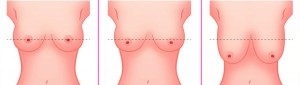 nipple areola