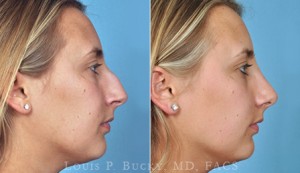 rhinoplasty-02c-wm