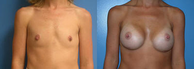 breast-augmentation-surgery