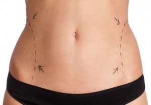 Laser-Liposuction