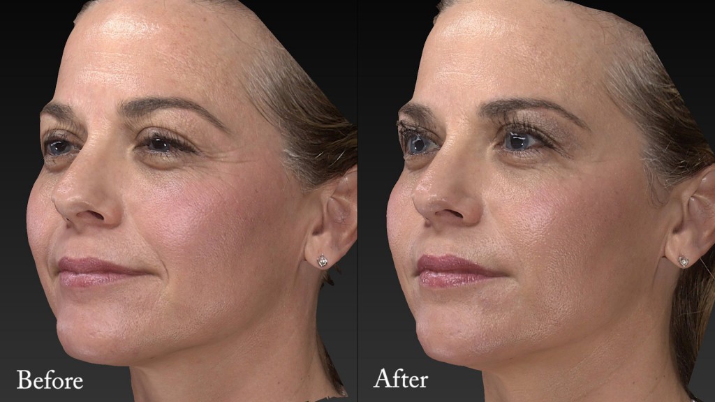 Before and After - Facial Rejuvenation