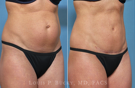 abdominoplasty-03b-wm