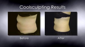 Coolsculpting before and after