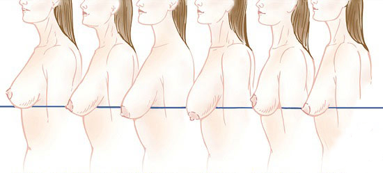 breast-lift-diagram-ptosis11