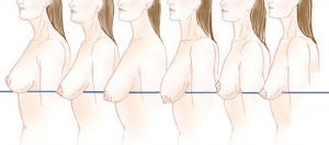 breast-lift-diagram-ptosis11