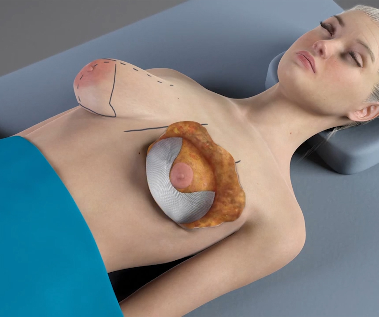 New Materials Show Promise for Lifting the Breast - The Plastic Surgery  Channel