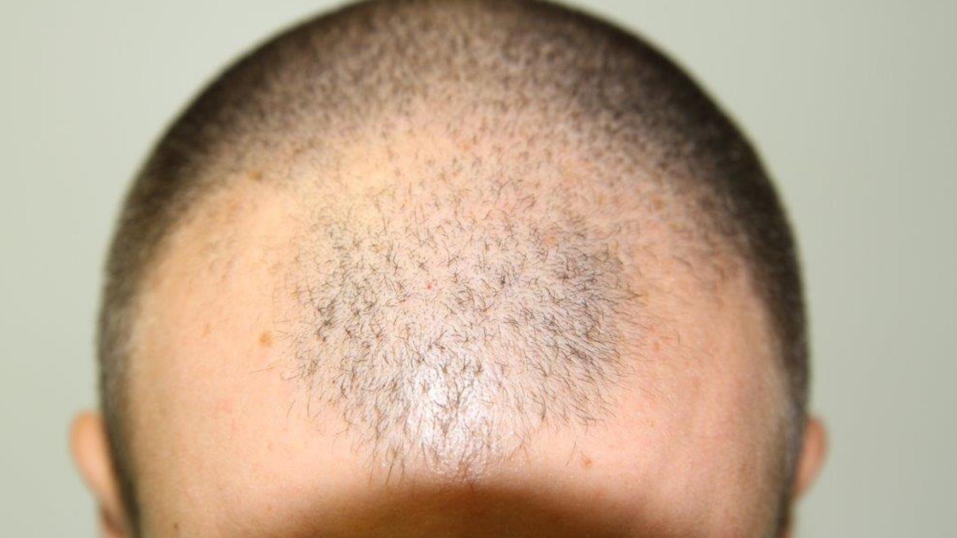 The Newest Treatment for Male Pattern Baldness  The Plastic Surgery Channel