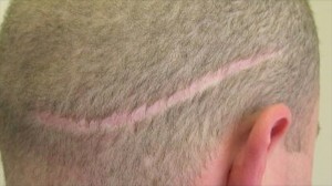 Strip Hair Transplant