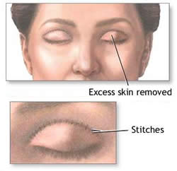 eyelid-surgery-in-Santa-Ana