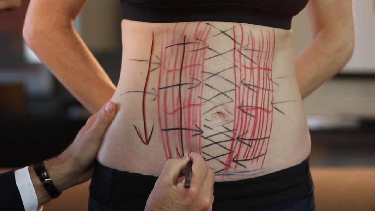 How To Get A Tight Tummy After Kids The Plastic Surgery Channel