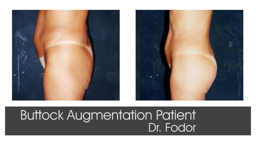 Buttock Augmentation