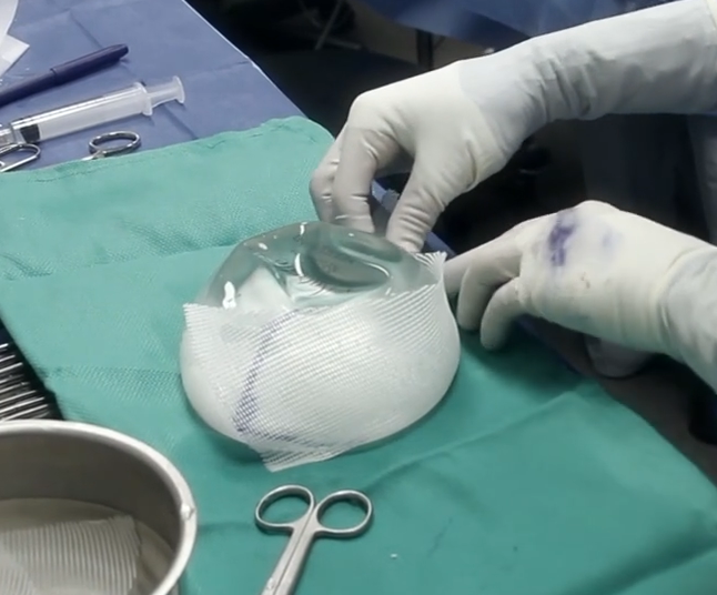 Internal Mesh 'Bra' Gives New Meaning to a Breast Lift - The Plastic  Surgery Channel